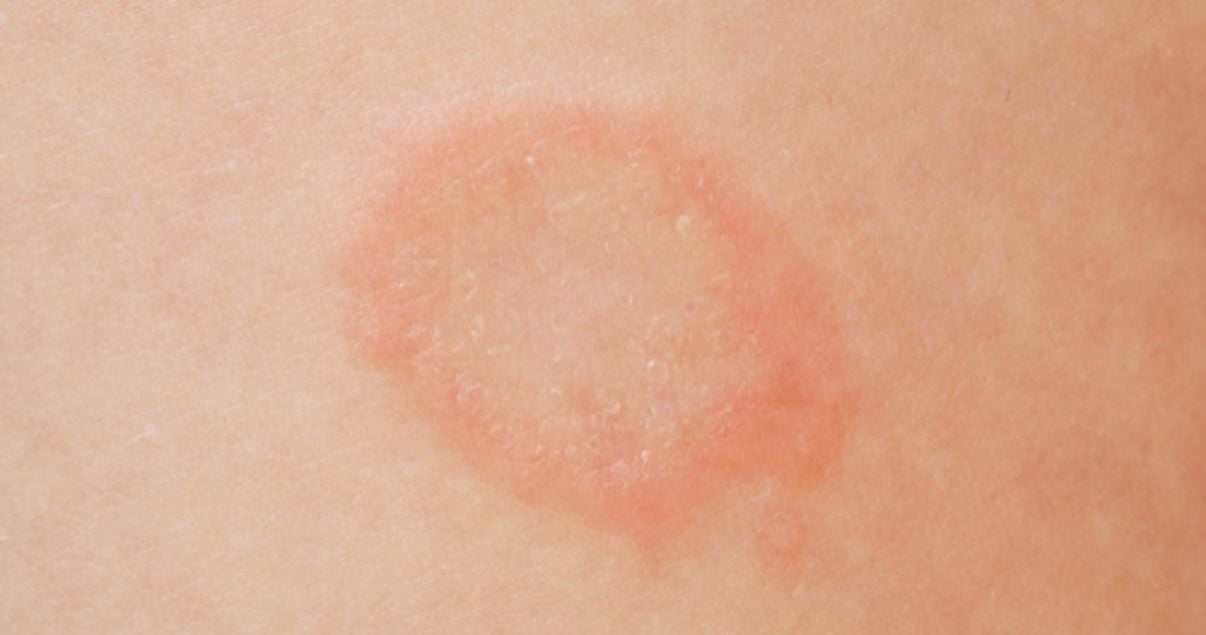 ringworm-causes-why-do-i-keep-getting-ringworm